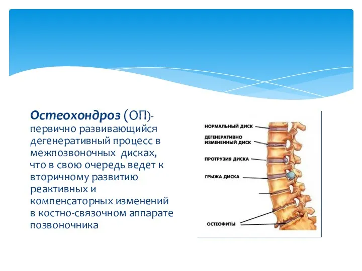 Остеохондроз (ОП)- первично развивающийся дегенеративный процесс в межпозвоночных дисках, что в