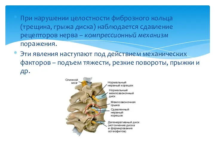 При нарушении целостности фиброзного кольца (трещина, грыжа диска) наблюдается сдавление рецепторов