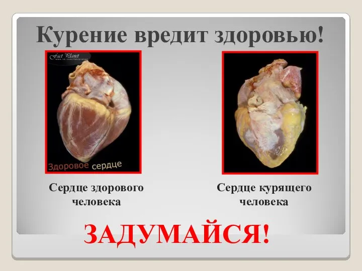 Курение вредит здоровью! ЗАДУМАЙСЯ! Сердце здорового человека Сердце курящего человека