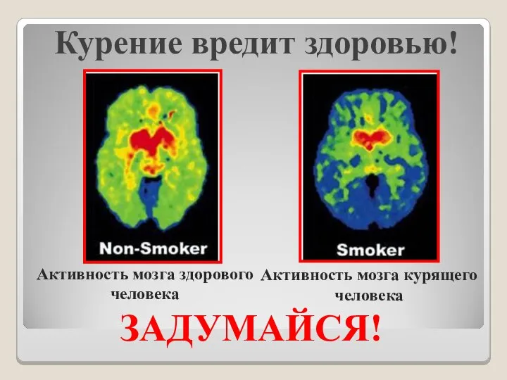 Курение вредит здоровью! ЗАДУМАЙСЯ! Активность мозга курящего человека Активность мозга здорового человека