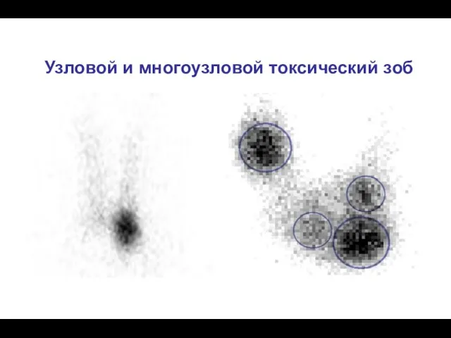 Узловой и многоузловой токсический зоб