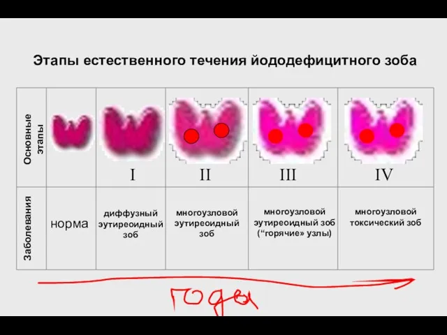 Этапы естественного течения йододефицитного зоба Основные этапы I II III IV