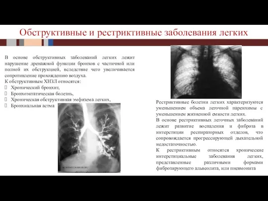 Обструктивные и рестриктивные заболевания легких В основе обструктивных заболеваний легких лежит