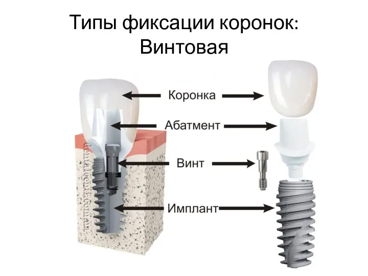 Типы фиксации коронок: Винтовая