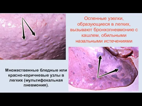 Оспенные узелки, образующиеся в легких, вызывают бронхопневмонию с кашлем, обильными назальными