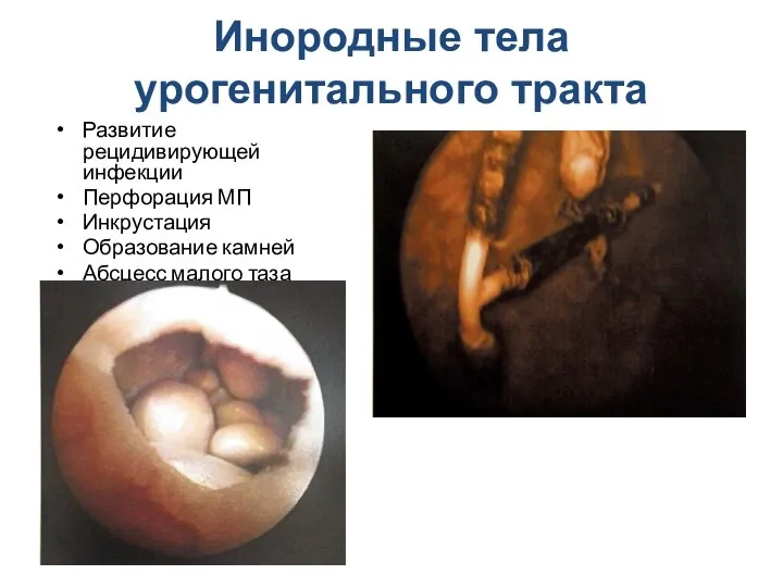 Инородные тела урогенитального тракта Развитие рецидивирующей инфекции Перфорация МП Инкрустация Образование камней Абсцесс малого таза