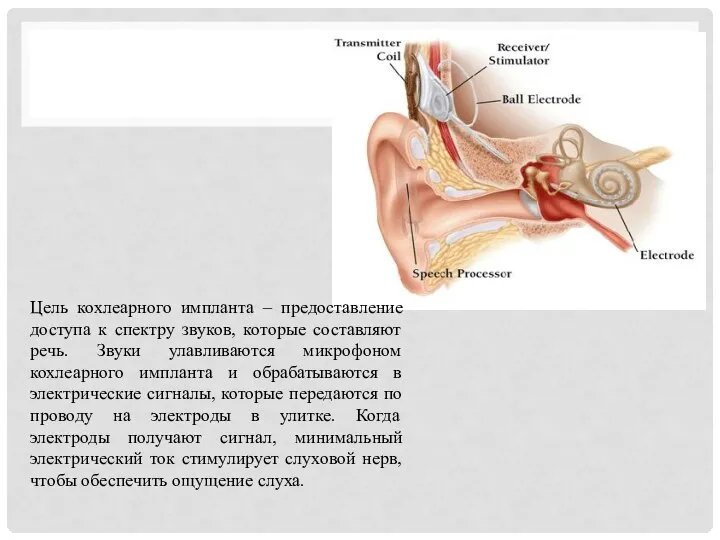 Цель кохлеарного импланта – предоставление доступа к спектру звуков, которые составляют