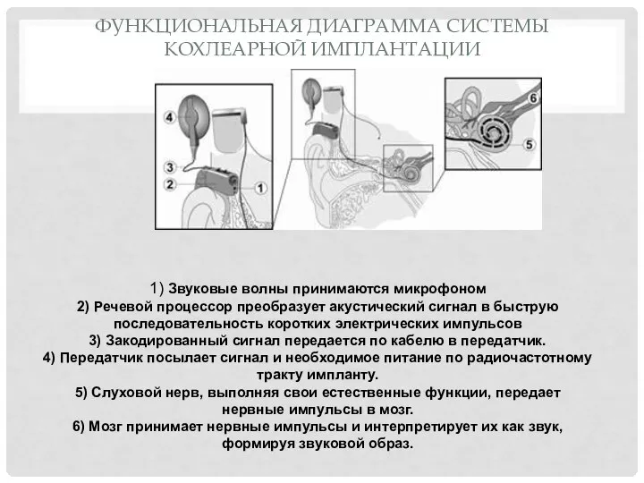 ФУНКЦИОНАЛЬНАЯ ДИАГРАММА СИСТЕМЫ КОХЛЕАРНОЙ ИМПЛАНТАЦИИ 1) Звуковые волны принимаются микрофоном 2)