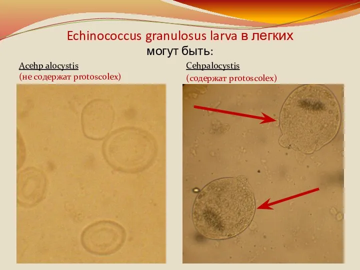 Echinococcus granulosus larva в легких могут быть: Cehpalocystis (содержат protoscolex) Acehp alocystis (не содержат protoscolex)