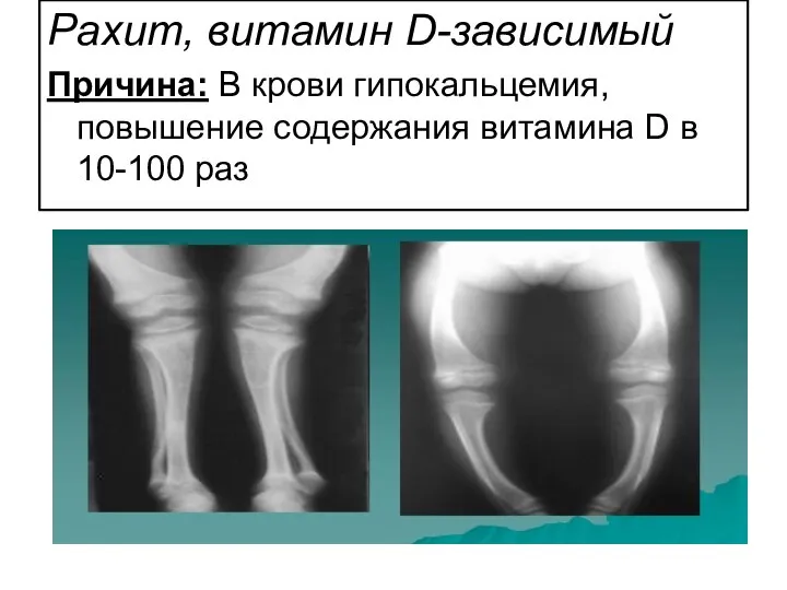 Рахит, витамин D-зависимый Причина: В крови гипокальцемия, повышение содержания витамина D в 10-100 раз