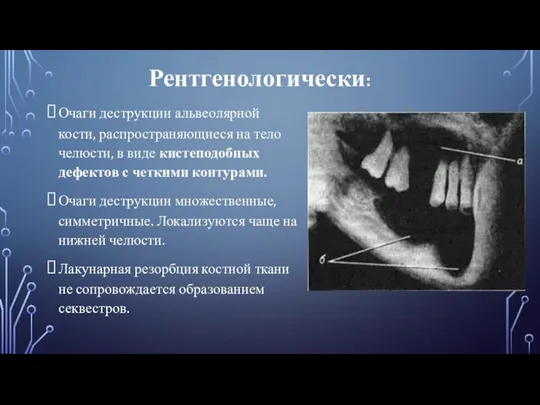 Рентгенологически: Очаги деструкции альвеолярной кости, распространяющиеся на тело челюсти, в виде