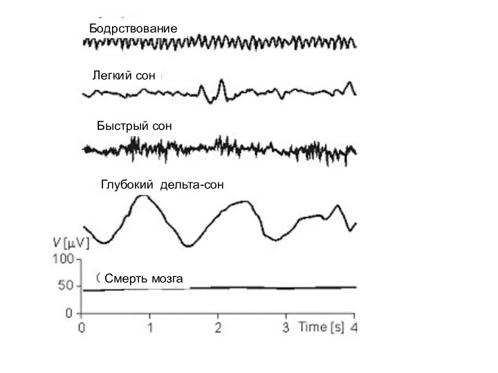 Бодрствование Легкий сон Быстрый сон Глубокий дельта-сон Смерть мозга