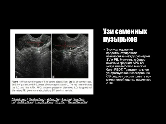 Узи семенных пузырьков Это исследование продемонстрировало взаимосвязь между размером SV и