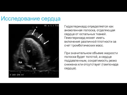 Исследование сердца Гидроперикард определяется как анэхогенная полоска, отделяющая сердце от остальных