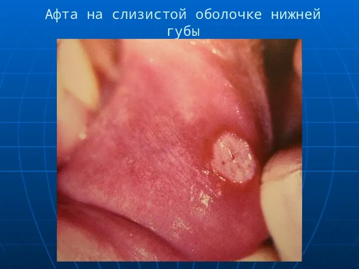 Афта на слизистой оболочке нижней губы