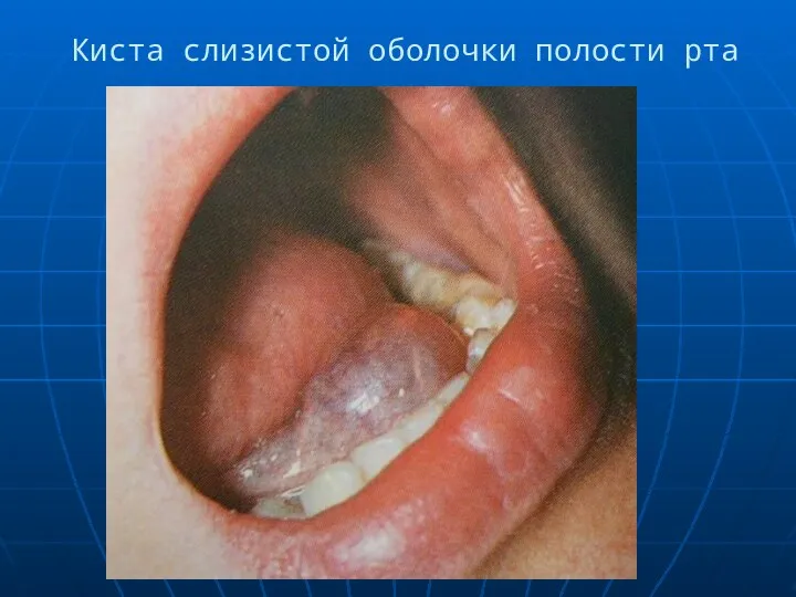 Киста слизистой оболочки полости рта