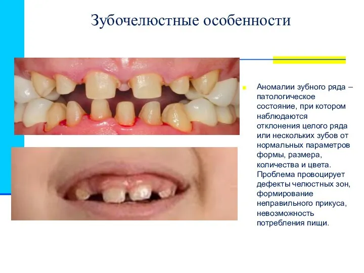 Зубочелюстные особенности Аномалии зубного ряда – патологическое состояние, при котором наблюдаются