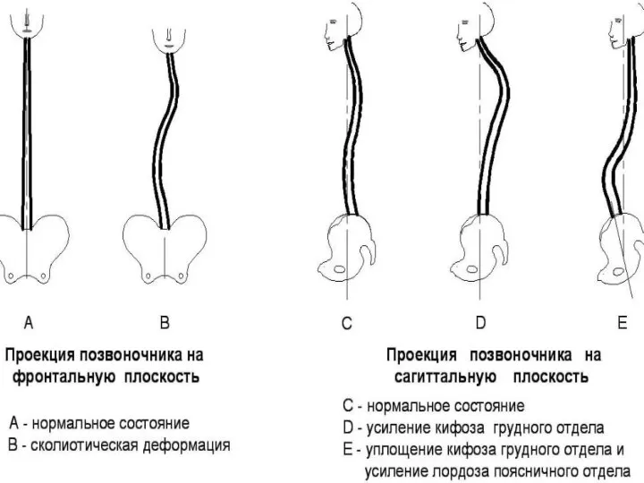Симптомы и синдромы поражения костной системы Синдром нарушения осанки Различают нарушение