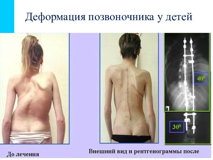 Деформация позвоночника у детей Поперечно-полосатая. Ф-ция опорно-двигательного аппарата(ходьба, жевание, глотание, дыхание,