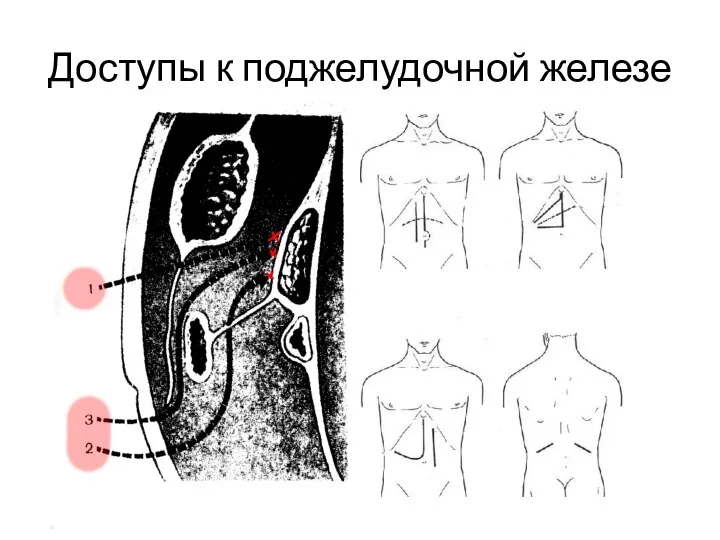 Доступы к поджелудочной железе