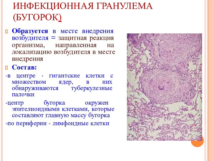 ИНФЕКЦИОННАЯ ГРАНУЛЕМА (БУГОРОК) Образуется в месте внедрения возбудителя = защитная реакция