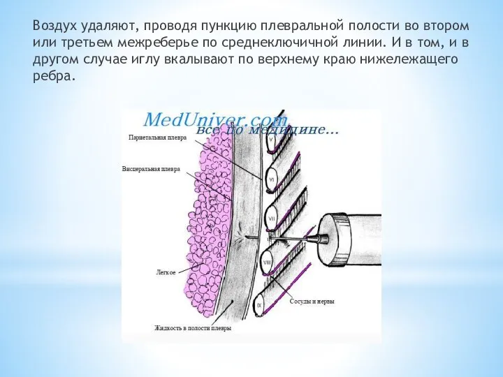 Воздух удаляют, проводя пункцию плевральной полости во втором или третьем межреберье