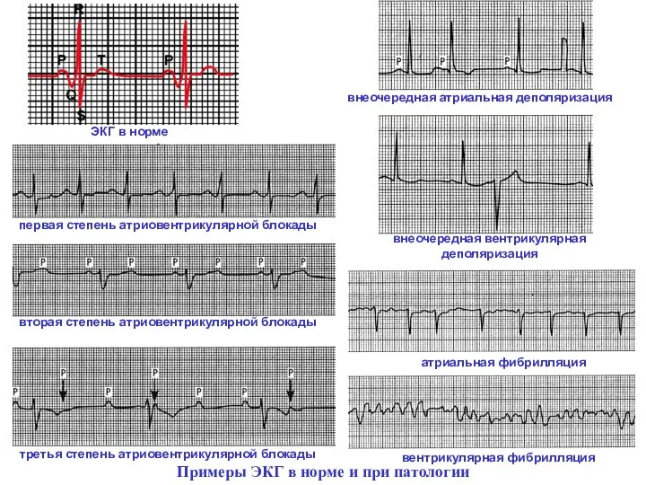 первая степень атриовентрикулярной блокады третья степень атриовентрикулярной блокады вторая степень атриовентрикулярной