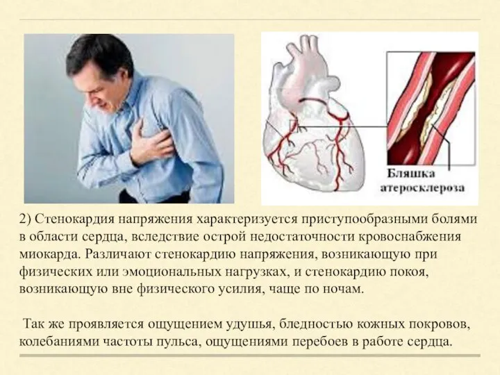 2) Стенокардия напряжения характеризуется приступообразными болями в области сердца, вследствие острой