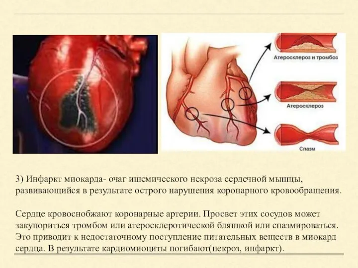 3) Инфаркт миокарда- очаг ишемического некроза сердечной мышцы, развивающийся в результате