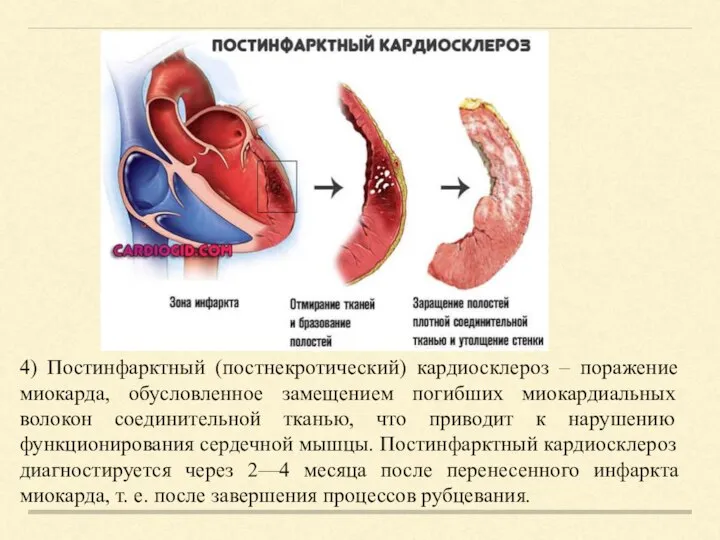 4) Постинфарктный (постнекротический) кардиосклероз – поражение миокарда, обусловленное замещением погибших миокардиальных