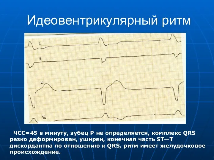 Идеовентрикулярный ритм ЧСС=45 в минуту, зубец Р не определяется, комплекс QRS