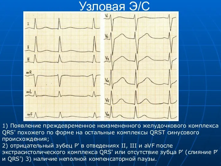 Узловая Э/С 1) Появление преждевременное неизмененного желудочкового комплекса QRS' похожего по