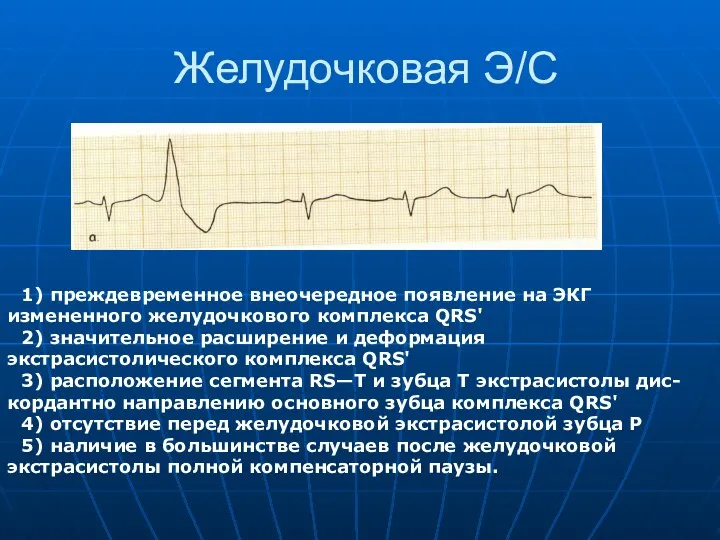 Желудочковая Э/С 1) преждевременное внеочередное появление на ЭКГ измененного желудочкового комплекса