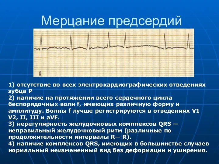 Мерцание предсердий 1) отсутствие во всех электрокардиографических отведениях зубца P 2)