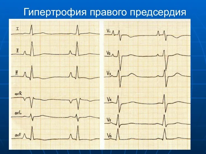 Гипертрофия правого предсердия