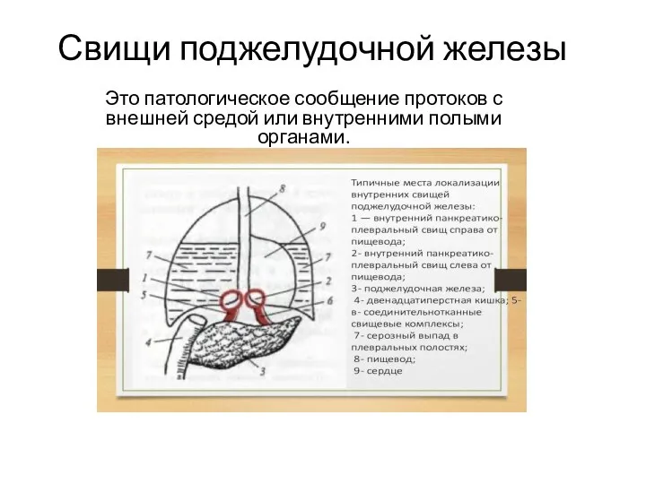 Свищи поджелудочной железы Это патологическое сообщение протоков с внешней средой или внутренними полыми органами.