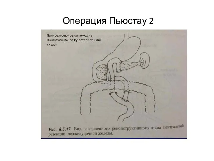 Операция Пьюстау 2