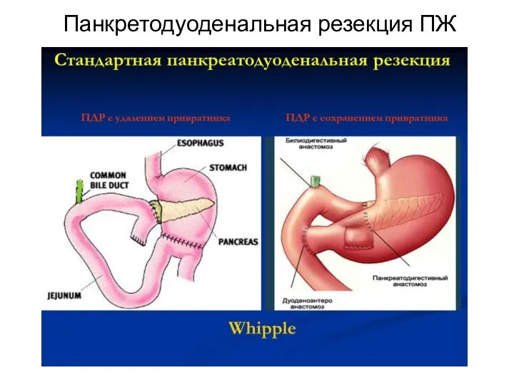 Панкретодуоденальная резекция ПЖ