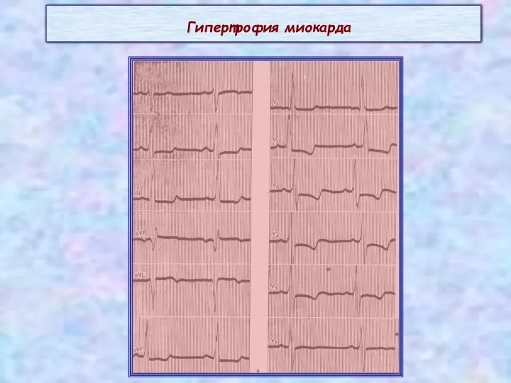 Гипертрофия миокарда