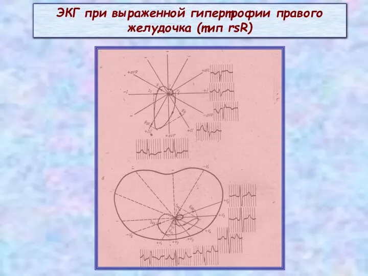 ЭКГ при выраженной гипертрофии правого желудочка (тип rsR)