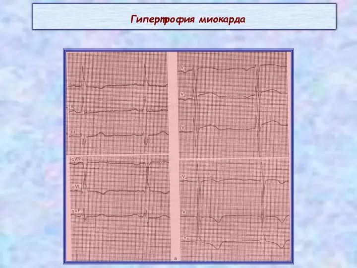 Гипертрофия миокарда