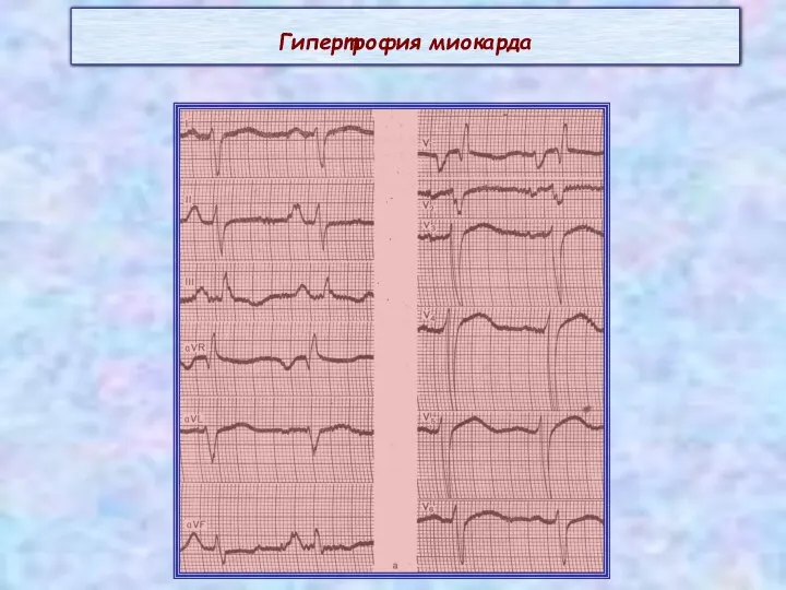 Гипертрофия миокарда