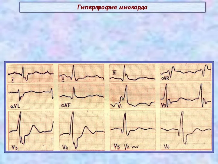 Гипертрофия миокарда