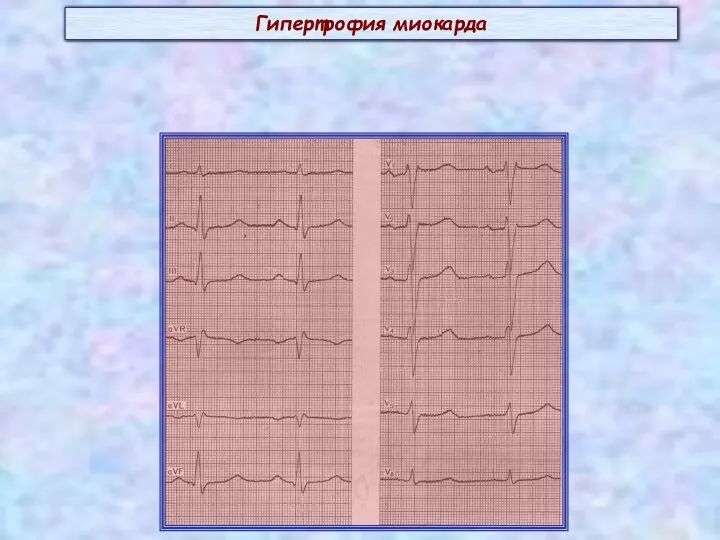 Гипертрофия миокарда