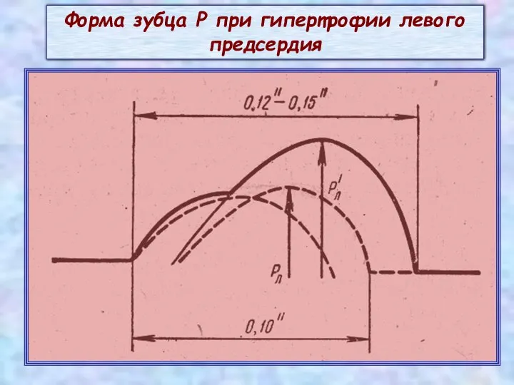 Форма зубца Р при гипертрофии левого предсердия