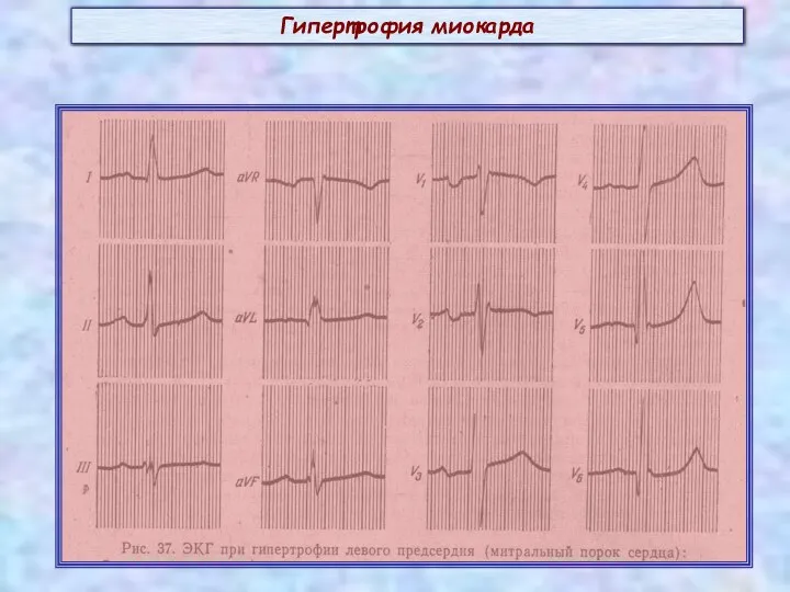 Гипертрофия миокарда