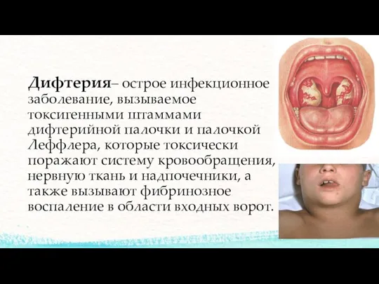 Дифтерия– острое инфекционное заболевание, вызываемое токсигенными штаммами дифтерийной палочки и палочкой