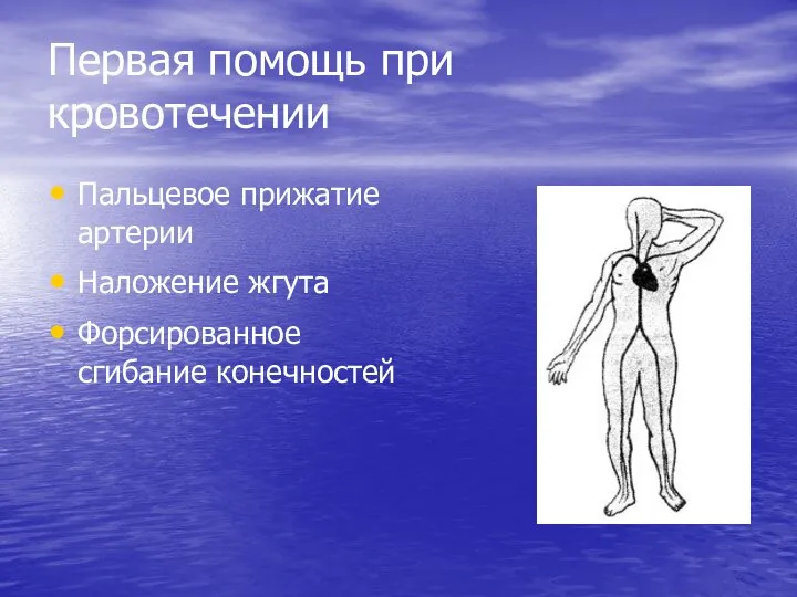 Первая помощь при кровотечении Пальцевое прижатие артерии Наложение жгута Форсированное сгибание конечностей