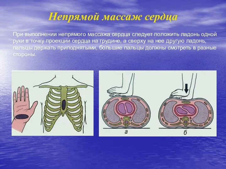 При выполнении непрямого массажа сердца следует положить ладонь одной руки в