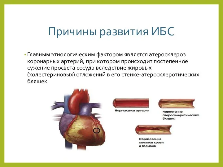 Причины развития ИБС Главным этиологическим фактором является атеросклероз коронарных артерий, при